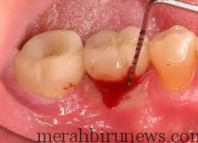 Tips Alami Mengatasi Gusi Berdarah